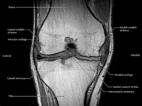 Las inyecciones de corticosteroides dañan el cartílago de la rodilla ...