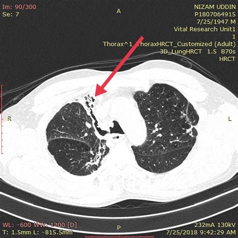 bronchiectasis radiology | apical pleural thickening ct | scattered fibrosis in lungs - CT Scan ...