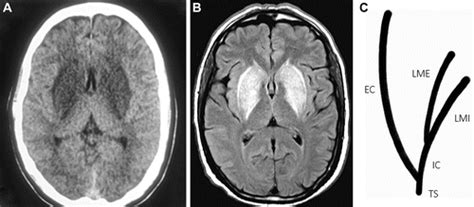 Uremic Encephalopathy | Radiology