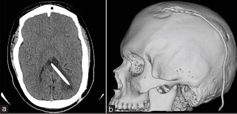 Figure 1 from Nuclear Medicine to Evaluate Complications of Cerebral ...