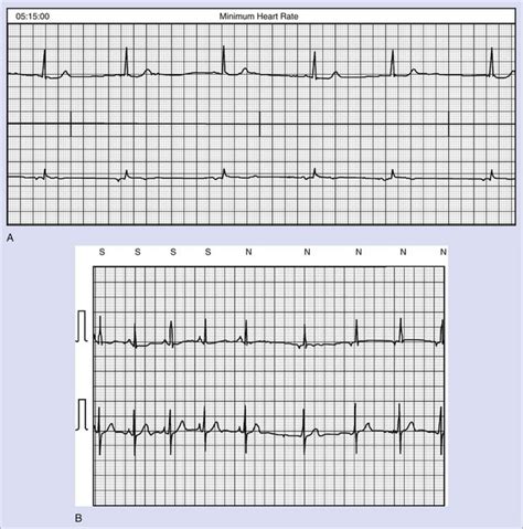 Sinus Node Dysfunction | Thoracic Key