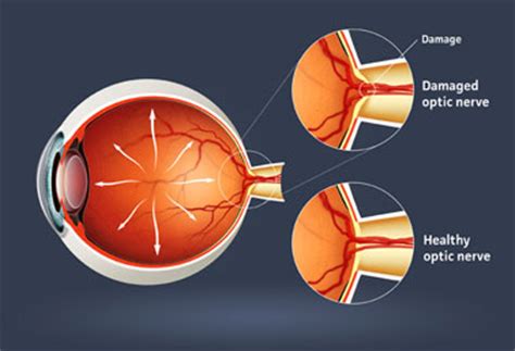 Optic Nerve Injuries; Optic Nerve Trauma; Optic Neuropathy, Traumatic ...