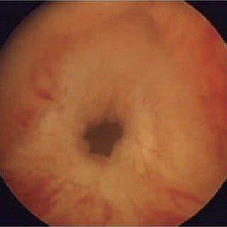 (PDF) Bladder neck contracture–incidence and management following contemporary robot assisted ...