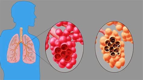 Emphysema and COPD | Everyday Health