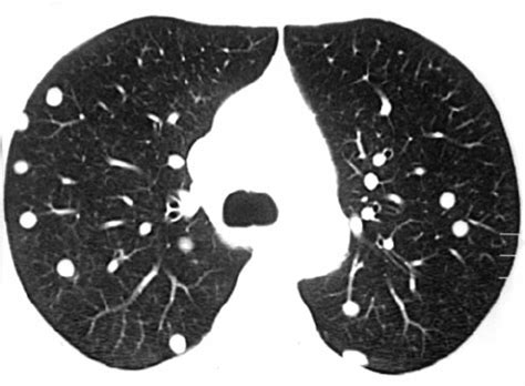 Helical CT scan with lung parenchyma window | Download Scientific Diagram