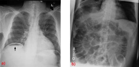 Gastrointestinal Perforation - Aetiology - Management - TeachMeSurgery