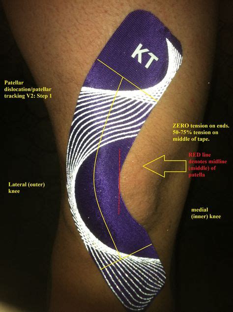 KT Tape for Patella Sublaxation | Kt tape knee, Knee taping, Kinesiology taping