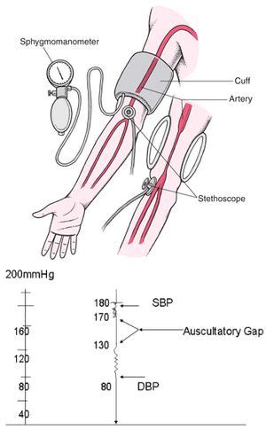 Auscultatory gap in hypertension | Medchrome