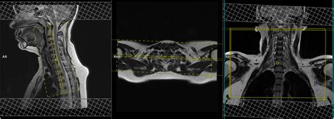 Brachial Plexus MRI Protocols, Planning and Indications