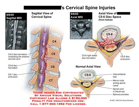 AMICUS Illustration of amicus,injury,cervical,spine,disc,herniation,C5-6,protrusion,thecal