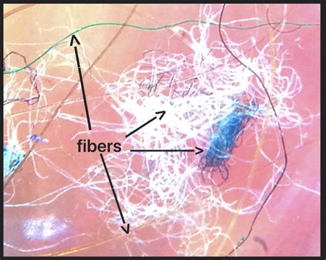 Morgellons Disease: The Basics — Donovan Hair Clinic