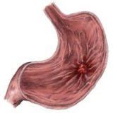 Peptic Ulcer - (Stomach Ulcer) Symptoms, Causes and Treatment