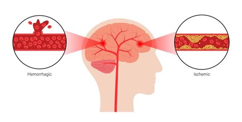 Ischemic vs Hemorrhagic Strokes: Types & Symptoms