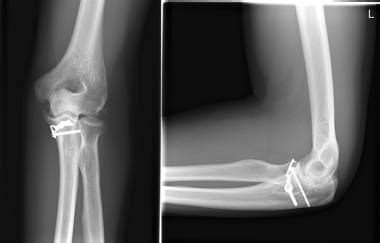 Coronoid Fracture Treatment & Management: Approach Considerations, Medical Therapy, Surgical Therapy