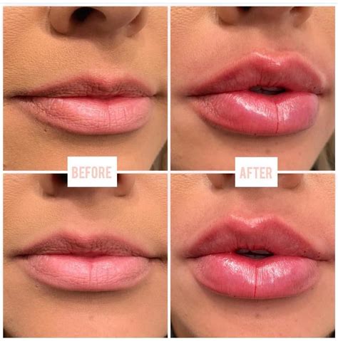 Lips by @lina_sev_ 1 Full Syringe of Juvederm Ultra XC Currently Taking appointments! Space is ...