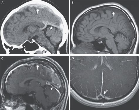 Cerebral Venous Thrombosis | NEJM