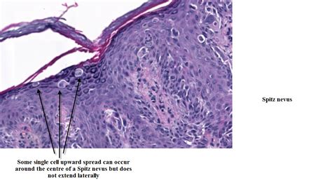 Dermpath Made Simple - Neoplastic: Spitz Nevus and Reed Nevus