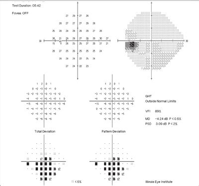 Sharpen Your Visual Field Interpretation Skills