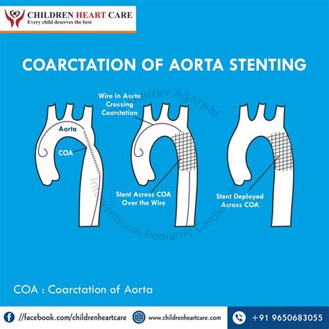 Coarctation of Aorta Treatment in Delhi - Dr. Gaurav Agrawal