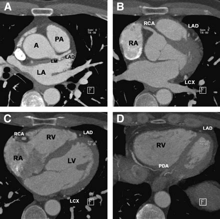 Coronary CT Angiography