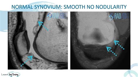 SYNOVITIS MRI FINDINGS KNEE WHAT DOES IT LOOK LIKE - Radedasia