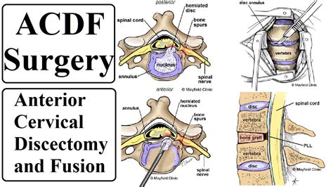 ACDF Surgery Day 650—March 21, 2017 - YouTube