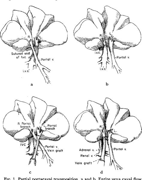 Surgical Portacaval Shunt (procedure) | Semantic Scholar