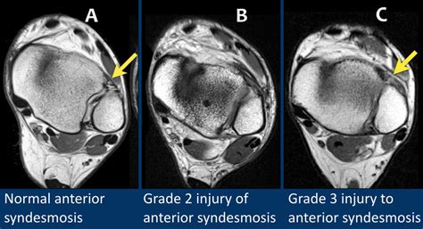 High Ankle Sprain Mri