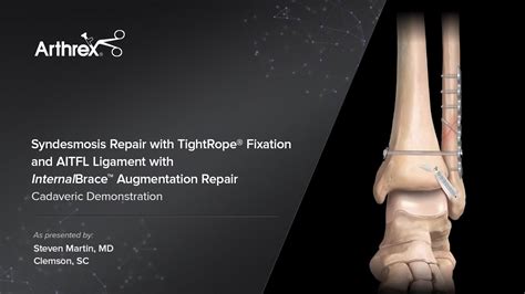 Arthrex - Syndesmosis Repair With TightRope® Fixation and AITFL ...