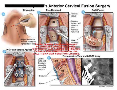 AMICUS Illustration of amicus,surgery,anterior,cervical,fusion,spine ...