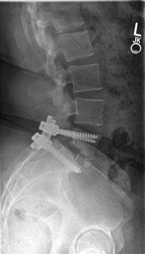 Adult Isthmic Spondylolisthesis - Spine - Orthobullets