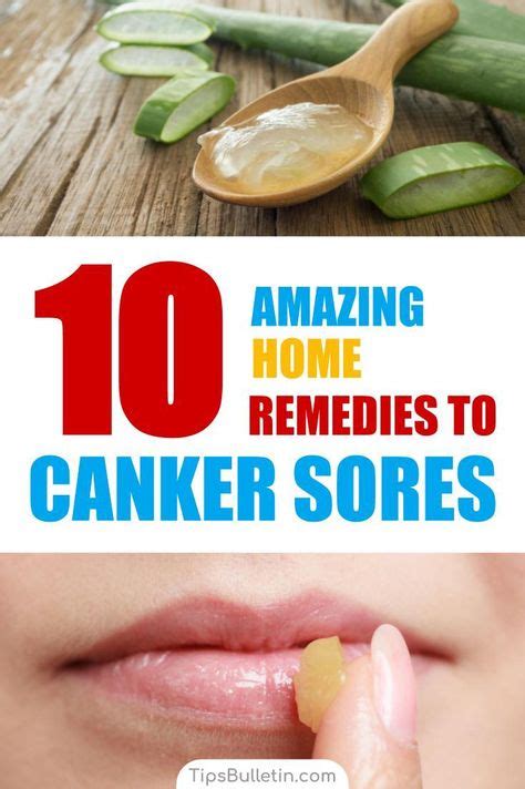 10 Amazing Homemade Solutions for Canker Sores in 2020 | Canker sore, Canker sore remedy, Cankers