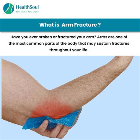 Arm Fracture: Causes and Treatment – Healthsoul