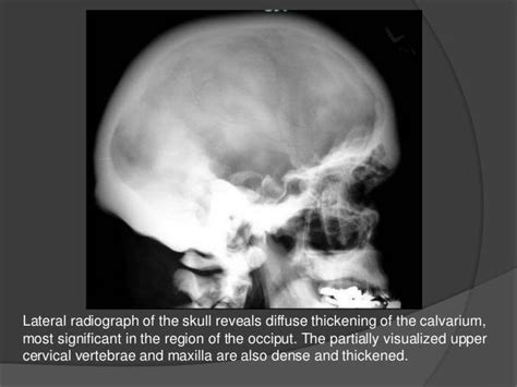 Osteopetrosis