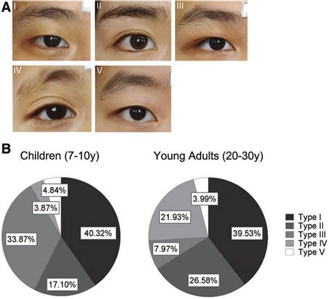 Representative forms of the 5 types of eyelid crease and their... | Download Scientific Diagram