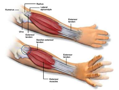 The F.A.S.T. Cure for Tennis Elbow (Lateral Epicondylitis) - Covenant ...