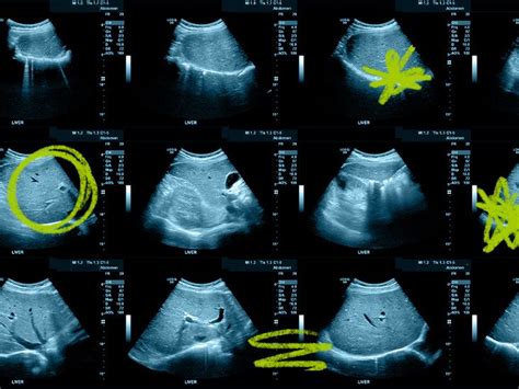 Abnormal results for liver ultrasound: what can they mean?