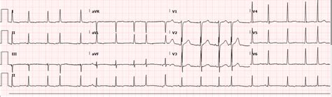 CMC ECG Monthly Session - EMERGENCY MEDICINE GUIDEWIRE