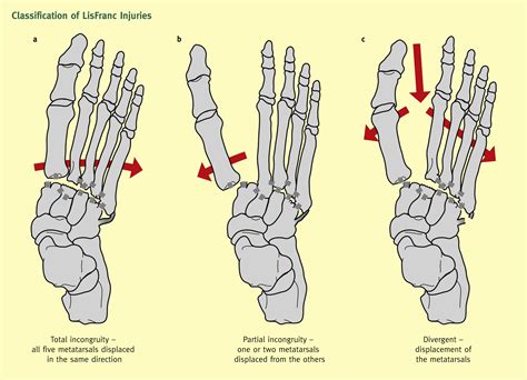 Fractures of the foot and ankle - Surgery - Oxford International Edition