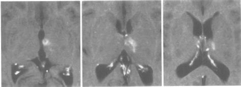 MRI of the thalamic region (phase T2), performed on the sixth day after ...