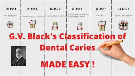 g v black classification of dental caries Archives - Dental Clinic