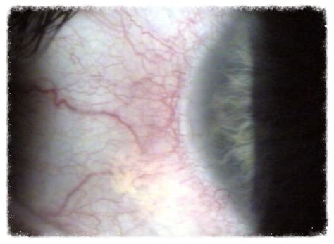 AZ Red Eye Experts - Advanced Treatment for Chronically Red Eyes - Phoenix Eye Care