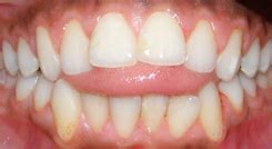 Tongue Thrust | Where Dentistry is done differently