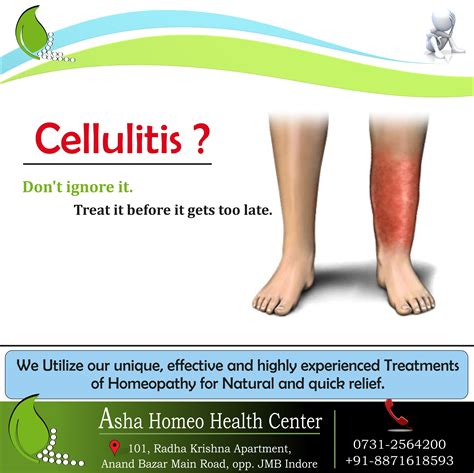 Cellulitis Treatment