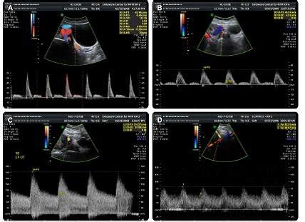 Uterine artery Doppler ultrasound in the nonpregnant and pregnant... | Download Scientific Diagram