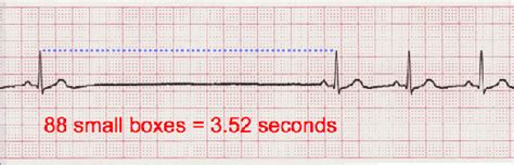 Sinus Rhythms: ECG class, criteria, tracings | PracticalClinicalSkills.com