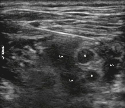 Ultrasound-Guided Peripheral Nerve Block Anesthesia with Emphasis on ...