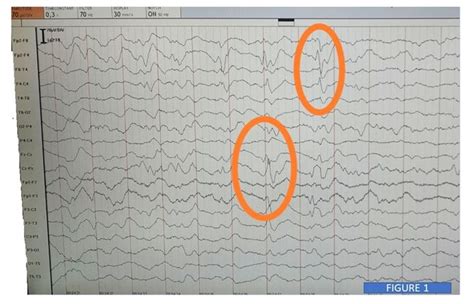 Triphasic Waves in EEG, an Atypical Finding in a Subacute Sclerosing Panencephalitis (SSPE ...