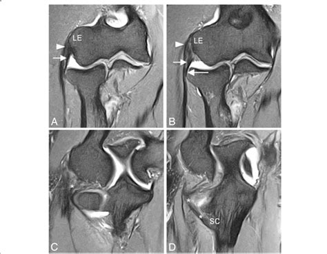 Ulnar Collateral Ligament Elbow Mri