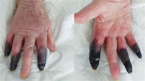 Italian woman has fingers amputated after bizarre COVID-19 symptoms ...